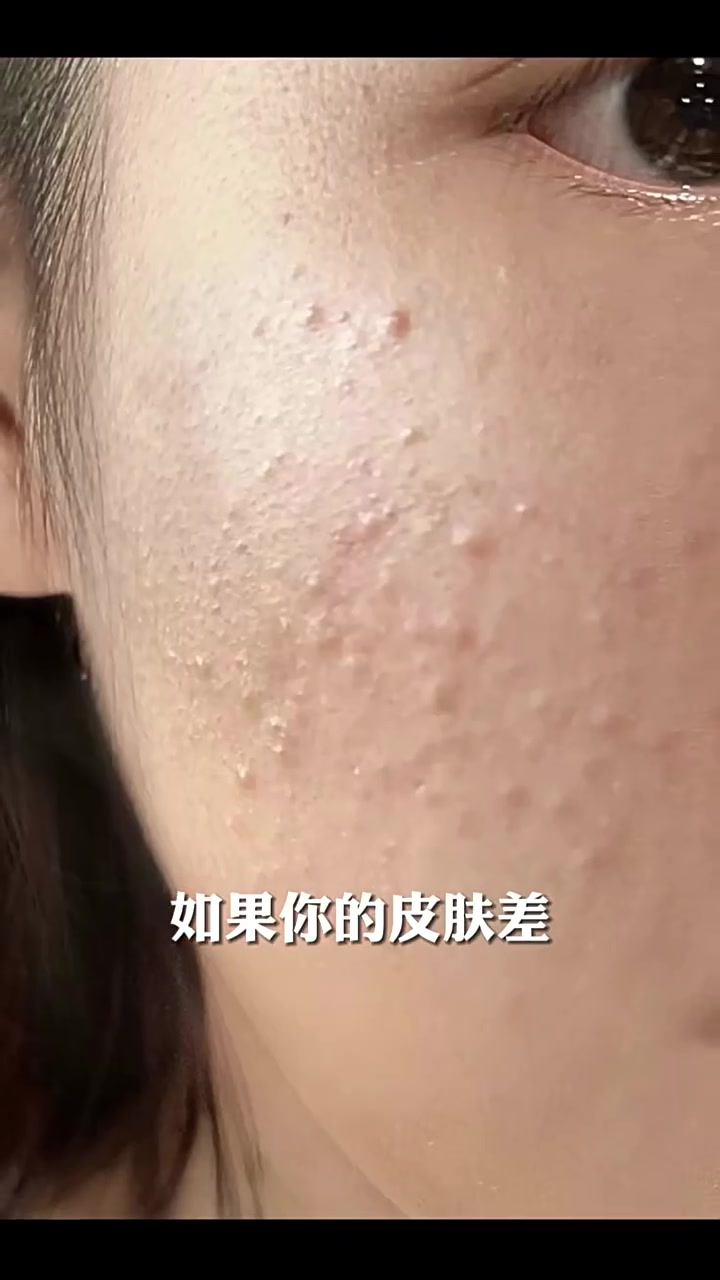 曼妮基小红帽：我的祛痘救星还是智商税？